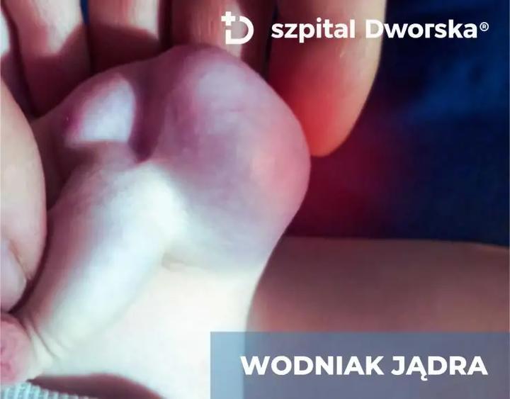 Kiedy udać się do lekarza z wodniakiem