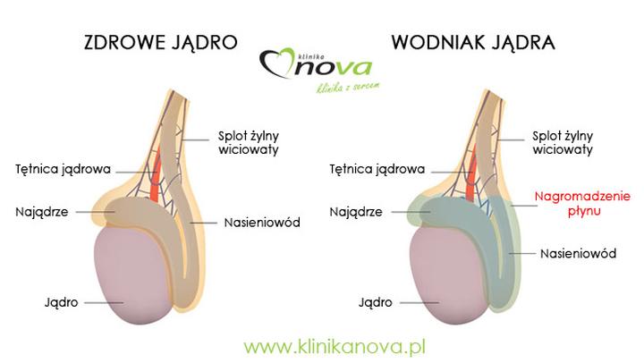 Objawy wodniaka jądra