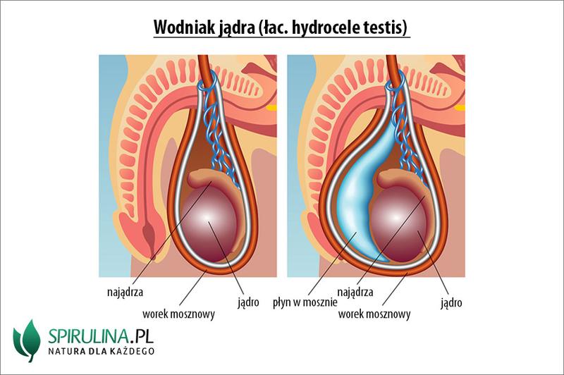 Wodniak jądra u dzieci