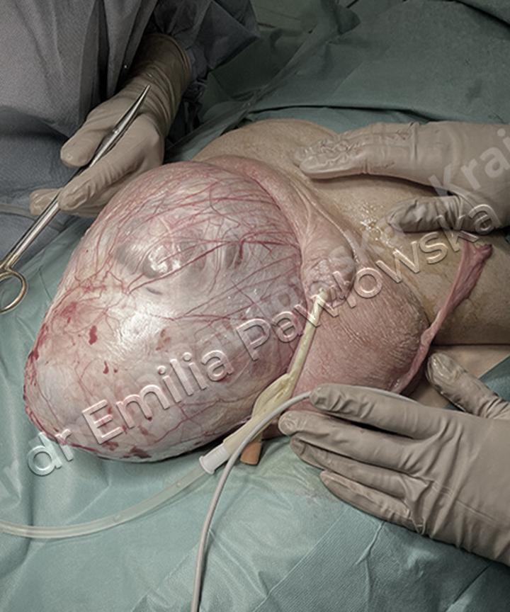 Wygląd moszny u dziecka