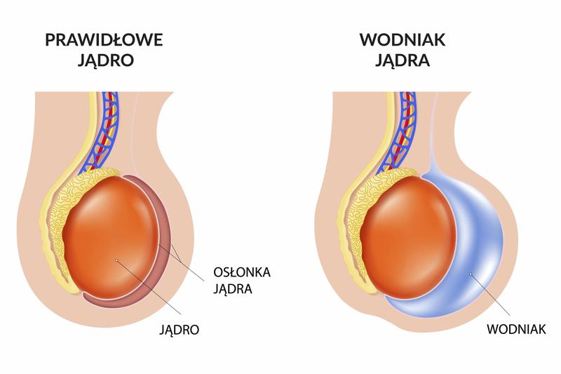 Wodniak jądra u dziecka – objawy, wygląd i moment, kiedy warto udać się do lekarza