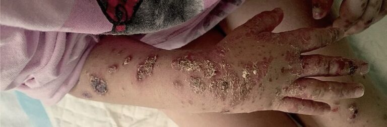 Kiedy dziecko ze strupami po ospie może wrócić do przedszkola? Ważne zasady i zalecenia