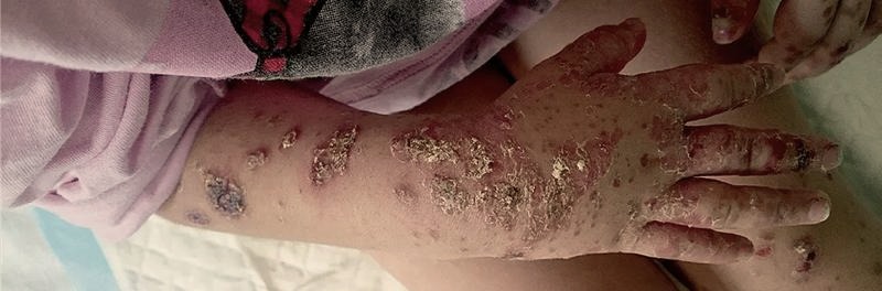 Kiedy dziecko ze strupami po ospie może wrócić do przedszkola? Ważne zasady i zalecenia